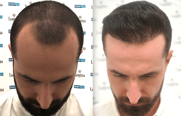 hair transplant in dubai book appointment name