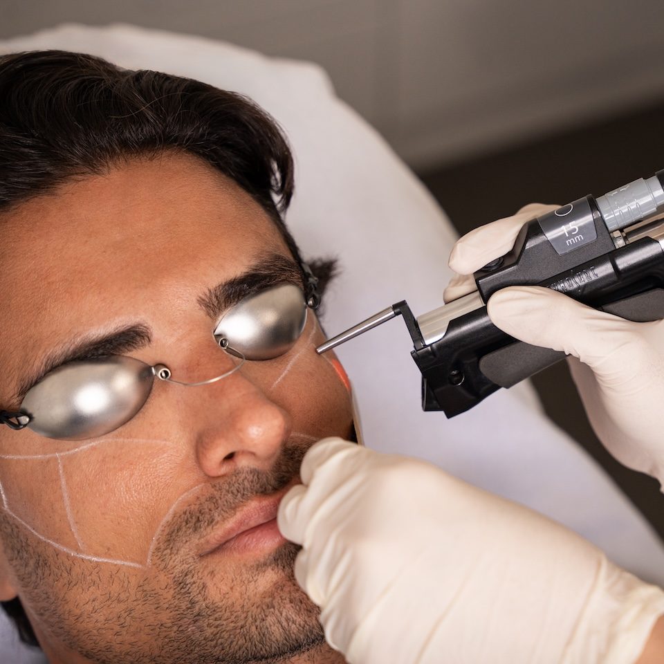 laser hair bleaching face