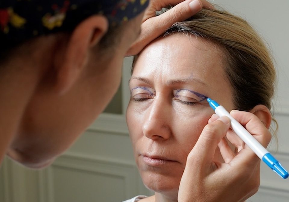 preps for blepharoplasty surgery